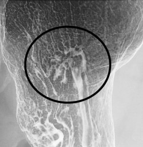 胃X線検査の撮影方法・画像の見方   第1種放射線取扱主任者試験対策